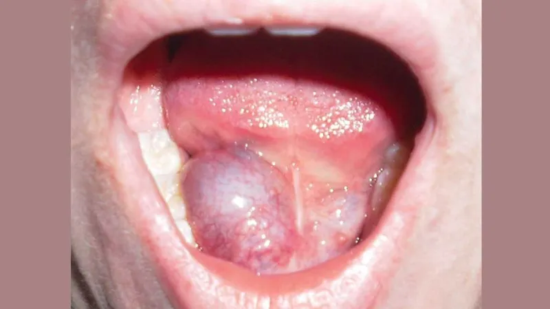 Oral ranula showing bluish translucent swelling