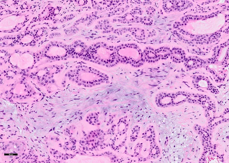 Histopathology of Pleomorphic Adenoma