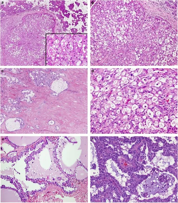 Histology of Salivary Gland Tumors