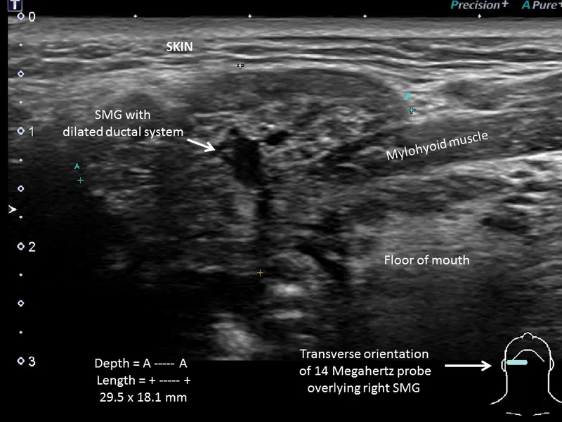 Ultrasound of sialadenitis with dilated duct