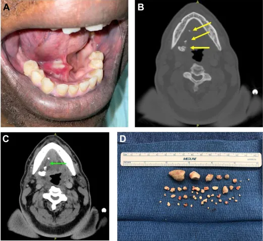 Sialolithiasis: Clinical, CT, and Excised Stones