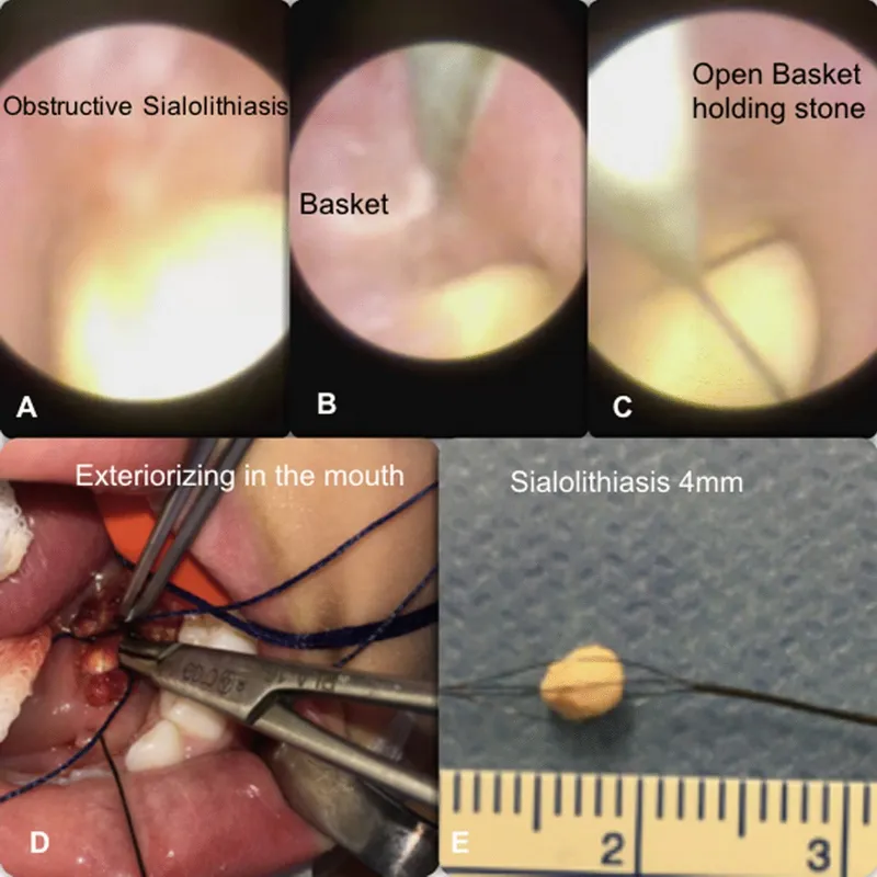 Sialendoscopy with basket retrieval of sialolith