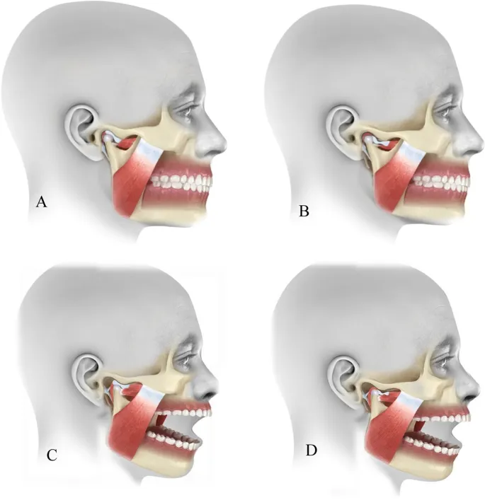 TMJ disc displacement stages