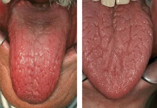 Dry, fissured tongue in xerostomia