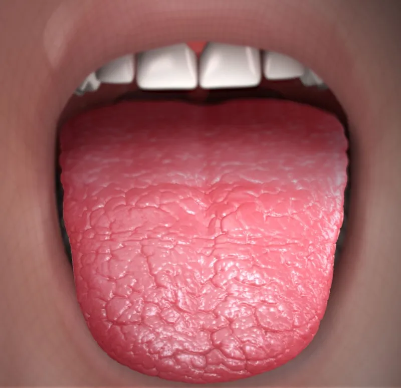 Dry, cracked oral mucosa in xerostomia