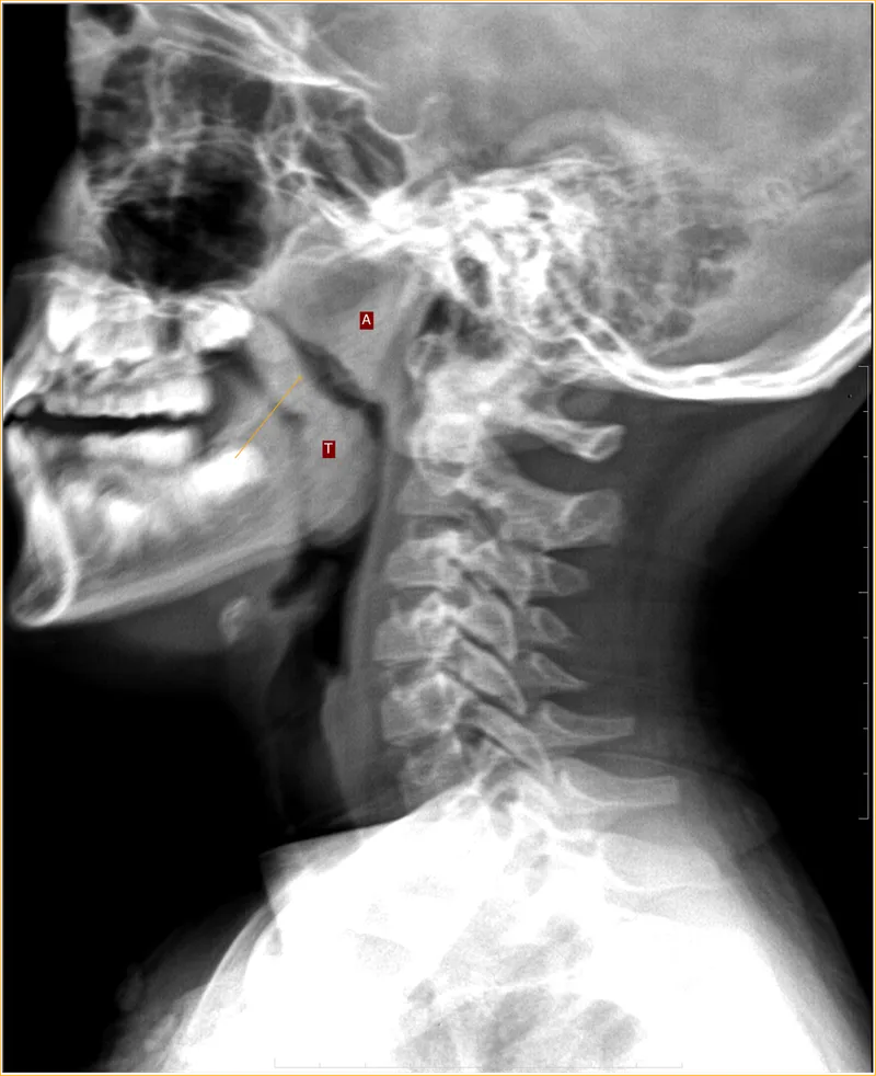 Lateral neck X-ray: Adenoid hypertrophy