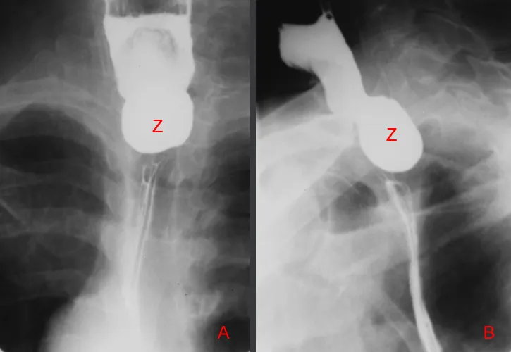 Zenker's diverticulum barium swallow