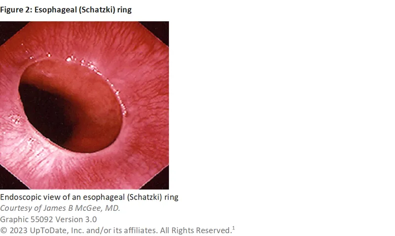 Endoscopic view of esophageal Schatzki ring
