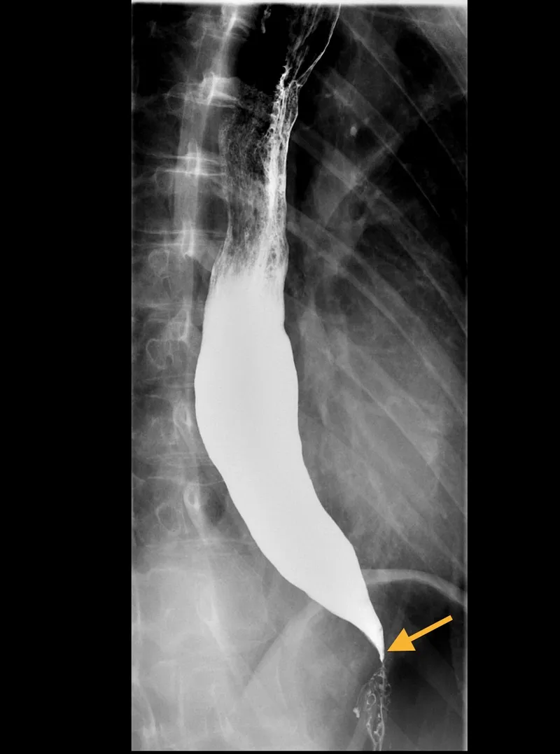 Barium swallow x-ray showing achalasia bird beak sign