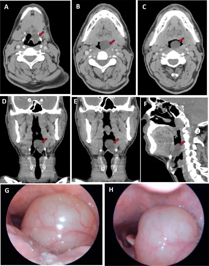 CECT neck with hypopharyngeal mass