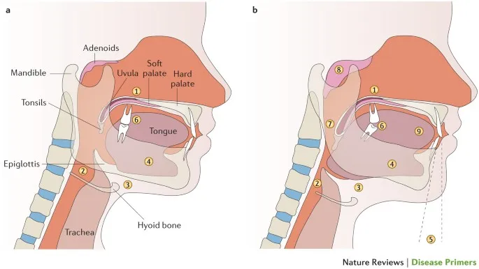 Upper airway anatomy in normal and OSA states