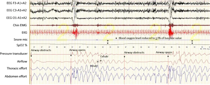 Polysomnography showing obstructive sleep apnea