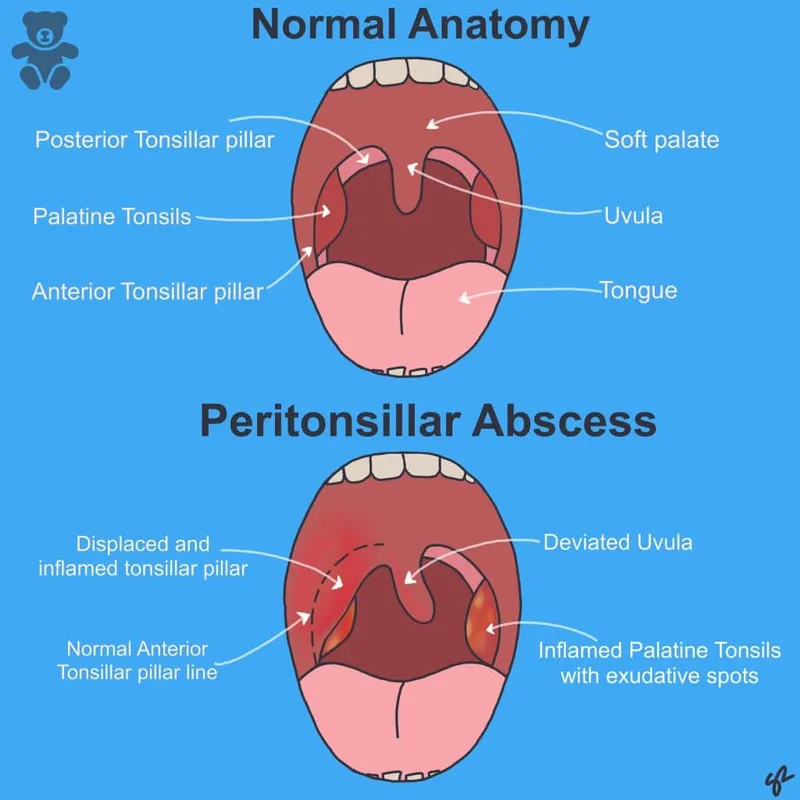 Peritonsillar Abscess vs Normal Anatomy