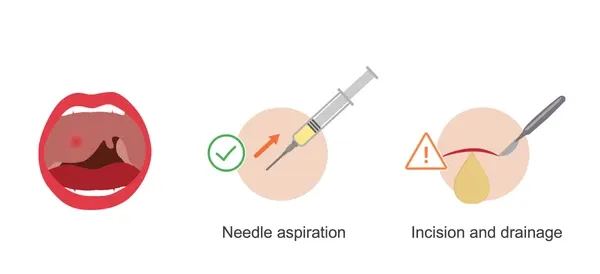 Peritonsillar abscess needle aspiration and incision
