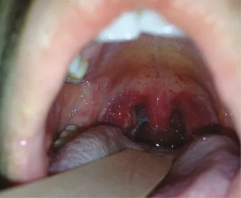 Pharyngitis with exudates and petechiae