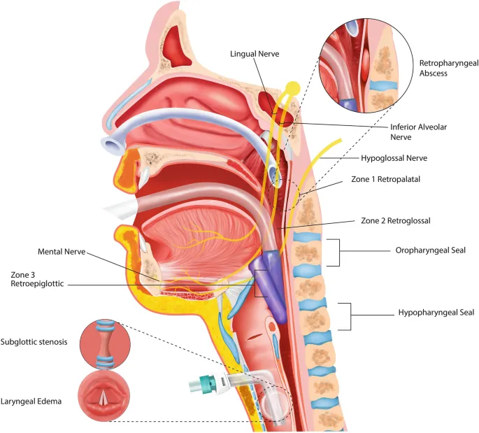 Sagittal view of upper airway collapse zones