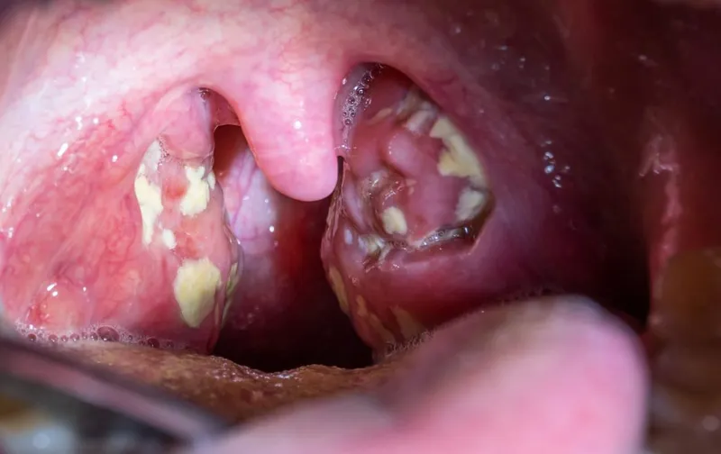 Acute tonsillitis with purulent exudates