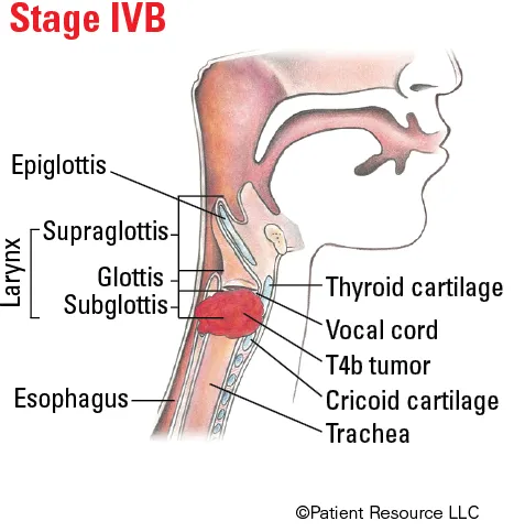 Laryngeal subsites and T4b tumor