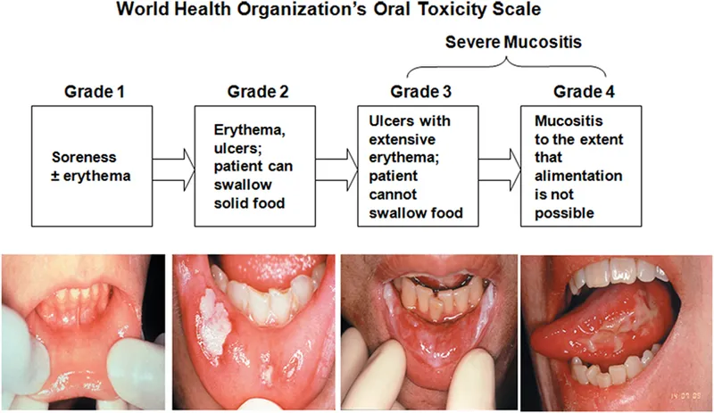 WHO Oral Toxicity Scale with clinical examples
