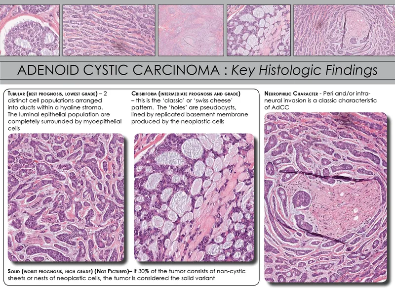 Adenoid Cystic Carcinoma Histopathology