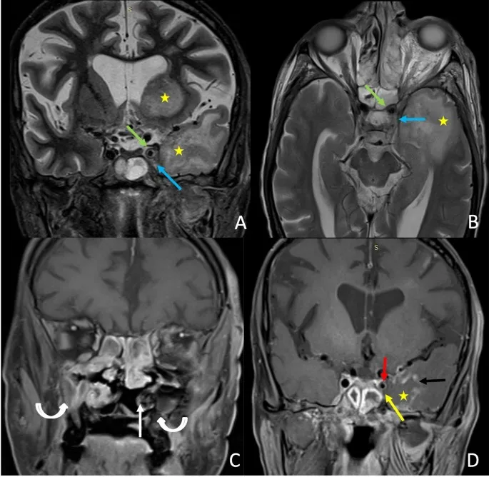 Sinonasal malignancy with orbital/skull base involvement