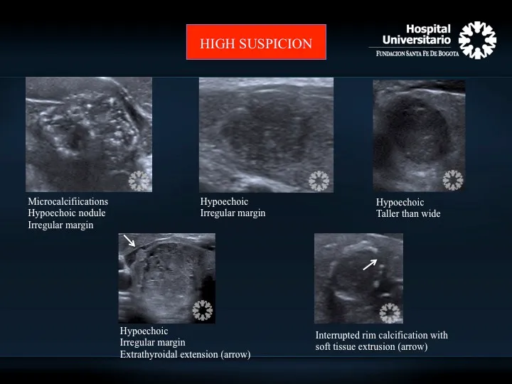 Ultrasound features of suspicious thyroid nodules
