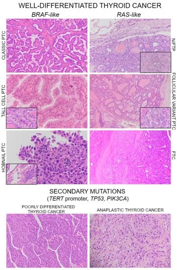 Histopathology of Thyroid Cancer Subtypes