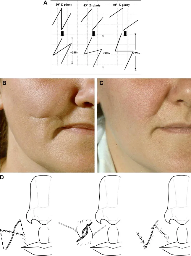 Z-plasty and W-plasty techniques for scar revision