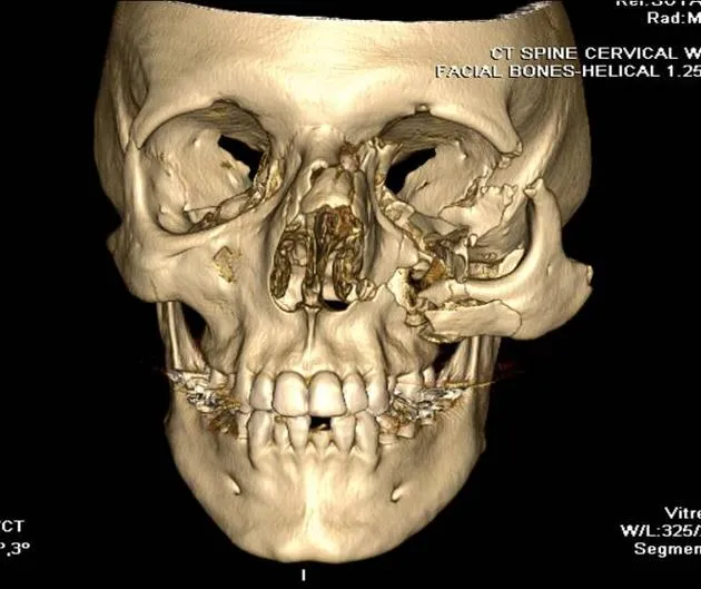 3D CT scan of complex facial trauma