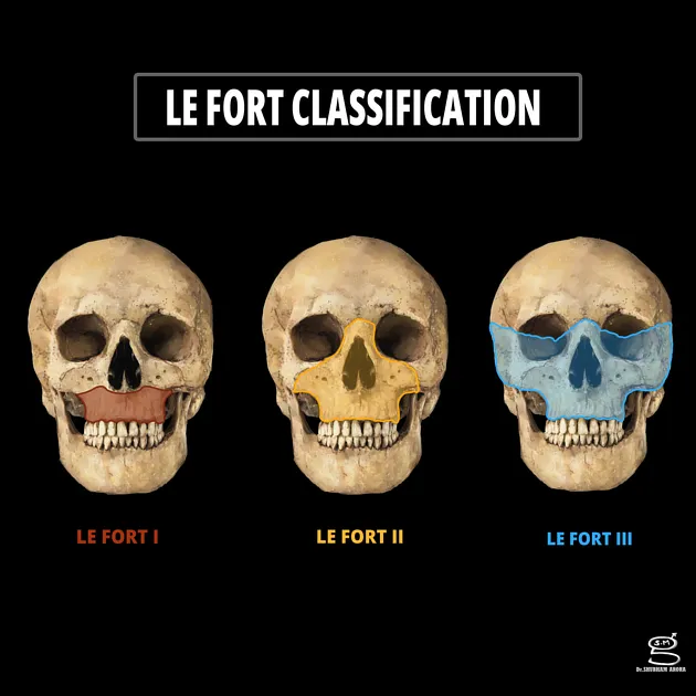 Le Fort I, II, and III Fracture Lines