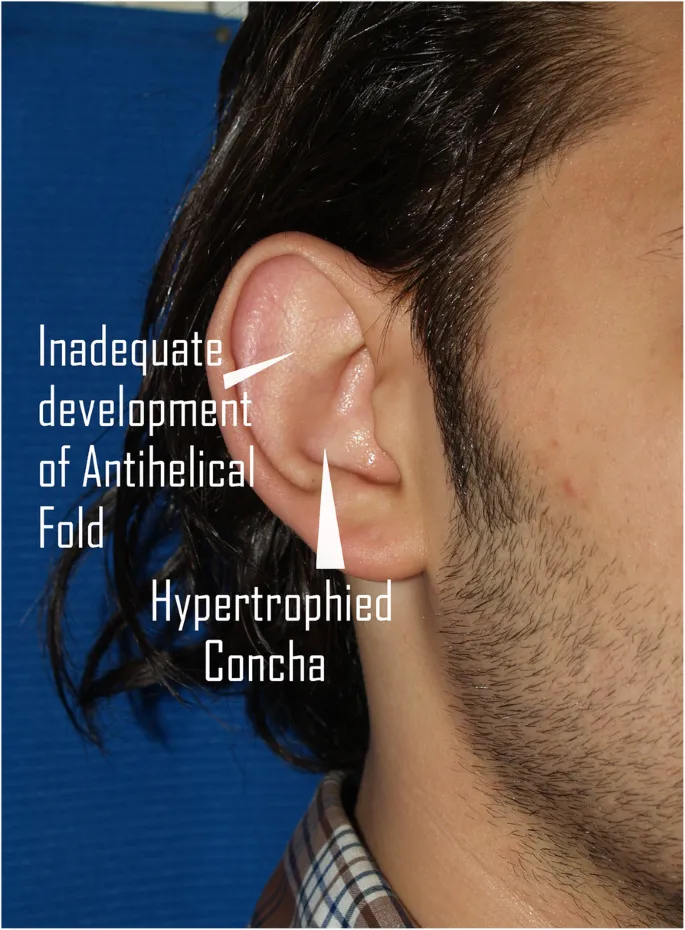 Causes of prominent ears: antihelix and conchal hypertrophy