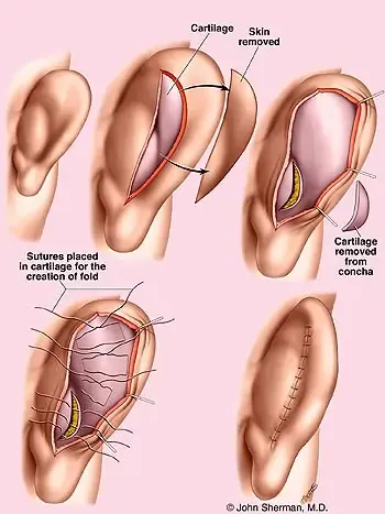 Otoplasty Surgical Steps