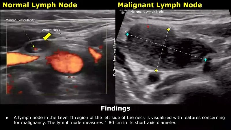Ultrasound: Normal vs Malignant Cervical Lymph Node
