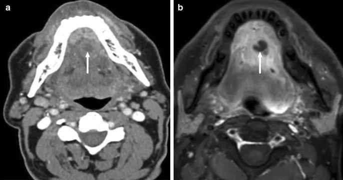 Axial CT and MRI of deep neck abscess