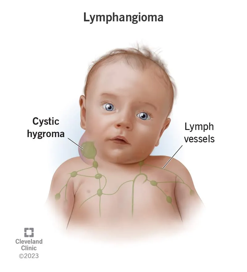 Lymphangioma (Cystic Hygroma) in an infant