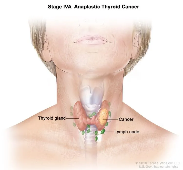 Anaplastic Thyroid Cancer with Lymph Node Metastasis
