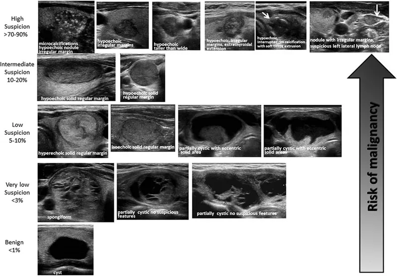 Ultrasound features of high-risk thyroid nodules