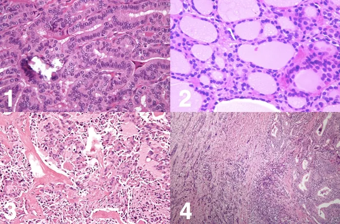 Histopathology of Thyroid Cancer Types