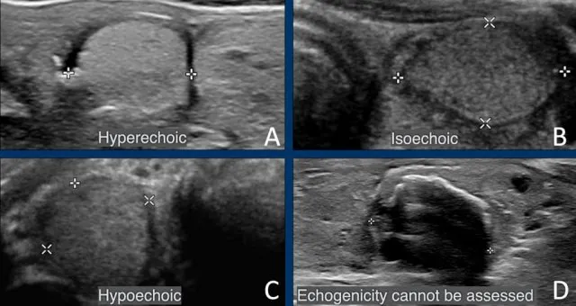 Thyroid Nodule Echogenicity