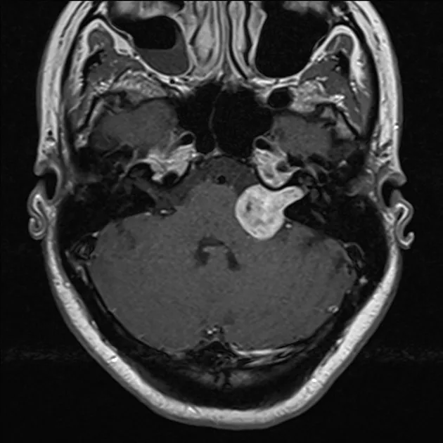 MRI showing acoustic neuroma with ice cream cone sign