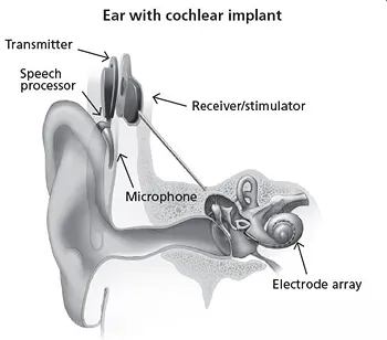 Cochlear implant components diagram