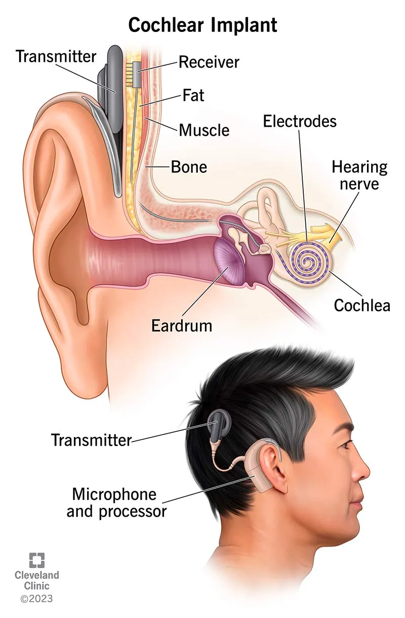 Cochlear Implant Components and Placement