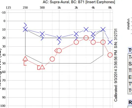 Audiogram: Low-frequency hearing loss