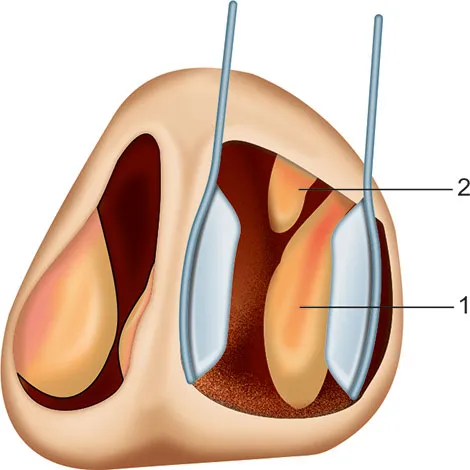 Anterior rhinoscopy view of nasal cavity
