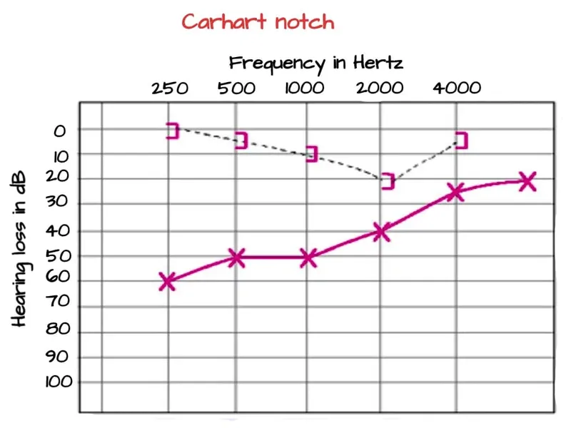 Audiogram: Carhart's notch in otosclerosis