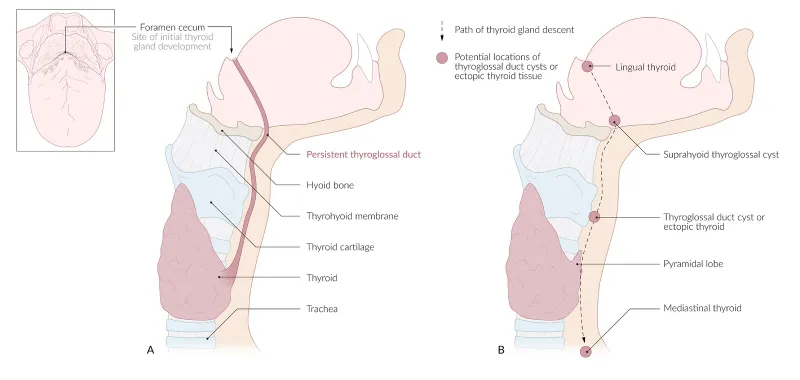 Thyroglossal duct development and potential cyst locations