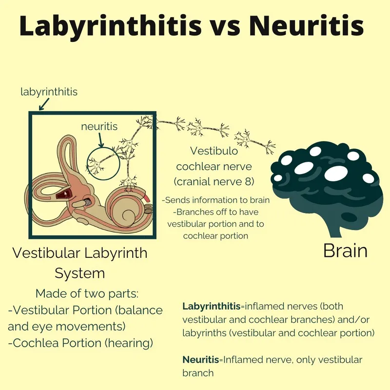 Labyrinthitis vs Neuritis Diagram