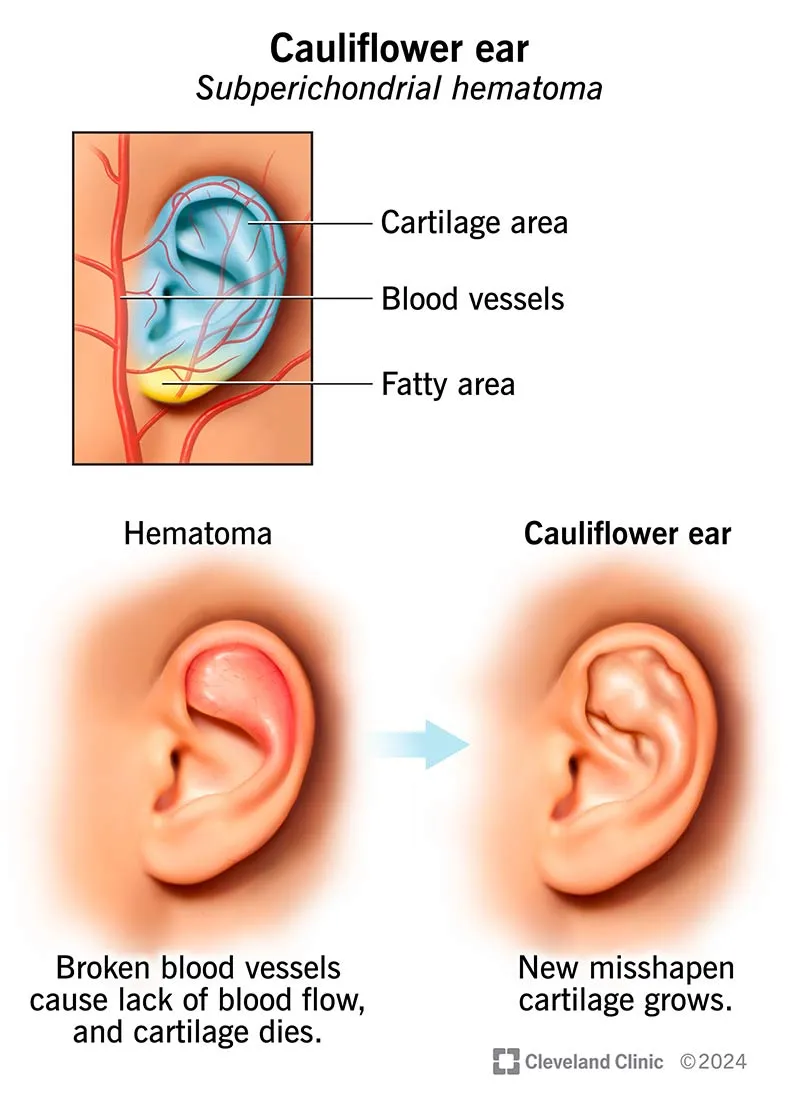 Cauliflower ear formation from subperichondrial hematoma