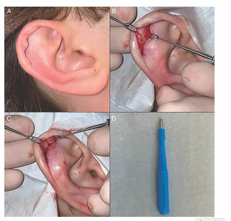 Auricular hematoma drainage procedure steps