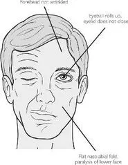 Facial Nerve Paralysis Clinical Features